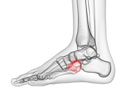 When the Cube-shaped Bone in Your Foot Becomes Dislocated