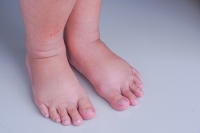 How Common Are Swollen Feet During Pregnancy?