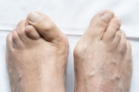 Facts About Bunion Surgery