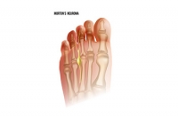 Morton’s Neuroma and High Heels