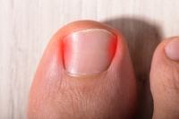 What Is a Nail Avulsion?