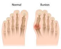 Treatment Options for Bunions