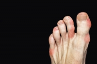 Can Gout Be Prevented?